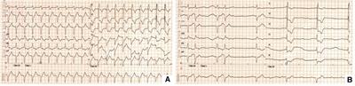 Case Report: Temporary pacing using active fixation lead and invasive electrophysiology studies for immune checkpoint inhibitor associated reversible advanced atrioventricular block